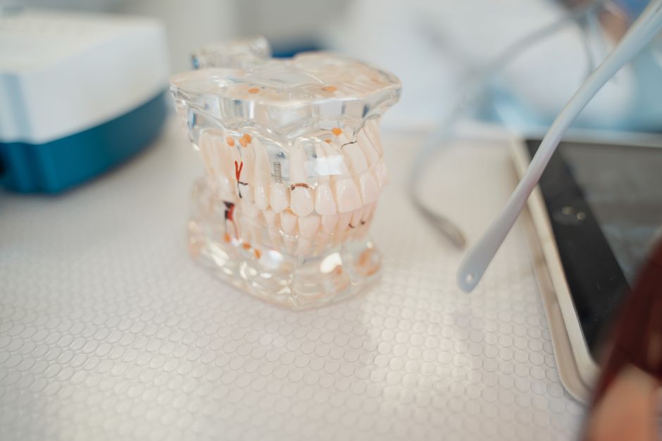 Los costos de los implantes dentales: Lo que debes saber